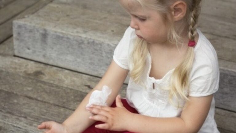 How to Avoid Topical Steroid Withdrawal?